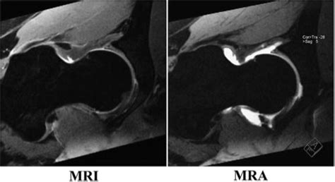 labral tear vs clicking sound